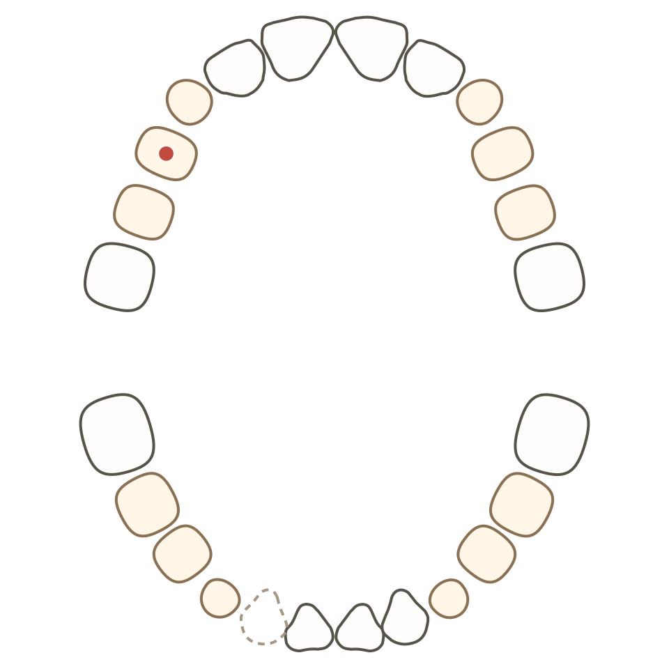 Mouth diagram of an eight-year-old: milk and permanent teeth mixed, one gap, one tooth marked with a problem dot