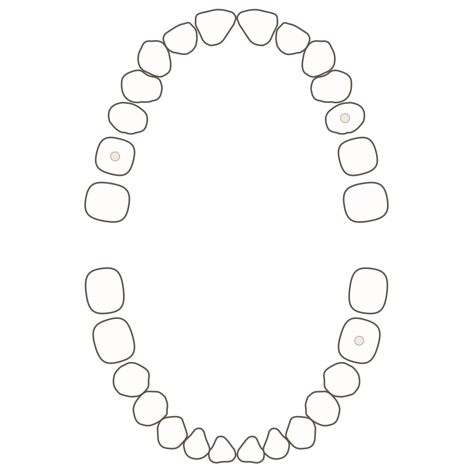 Mouth diagram of a teenager: full permanent dentition, three teeth with subtle filling markers